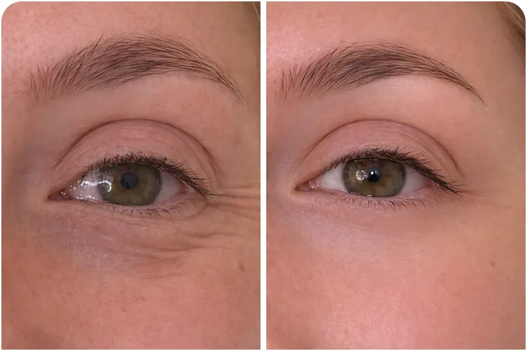 Crow’s feet treatment before and after Bournemouth eye wrinkle results