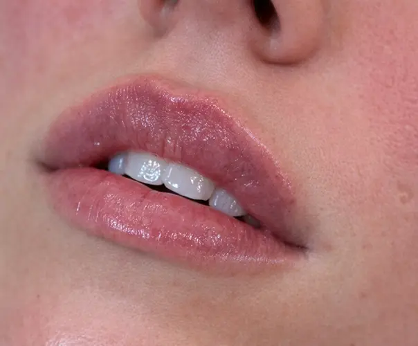 Lip filler treatment Bournemouth dermal filler lips 1ml natural enhancement