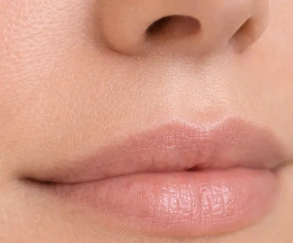 Nasolabial fold filler Bournemouth smile lines treatment 1ml