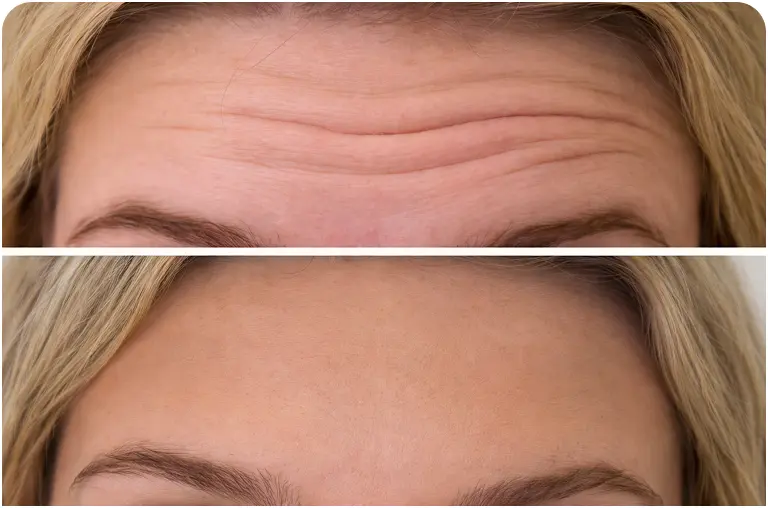 Forehead wrinkle treatment before and after Bournemouth anti wrinkle results