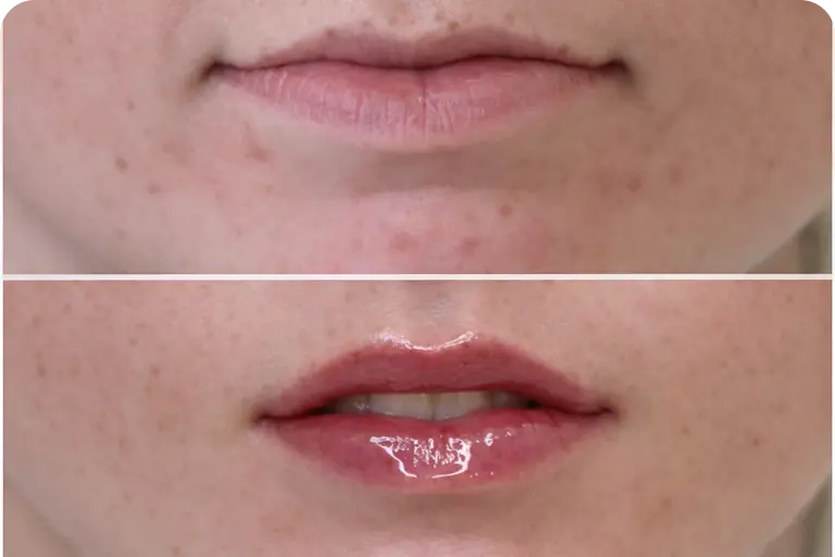 Lip filler before and after Bournemouth natural lip enhancement results
